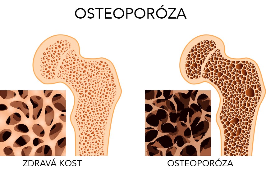 Ilustrace zdravé kosti a kosti s osteoporózou – úbytek kostní hustoty